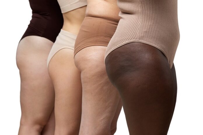 lipedema
